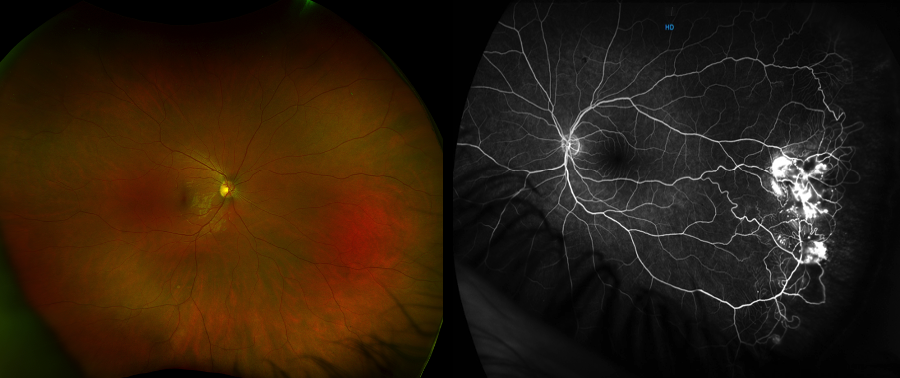 Coats-like retinopathy