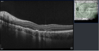 Scattered incomplete outer retinal and RPE atrophy OU