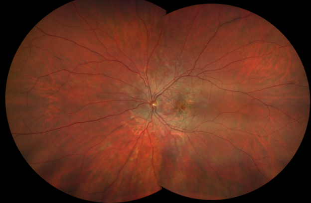 Placoid pigmentary lesions in the macula and peripapillary region OU. FAF revealed mottled hyperautofluorescence with hypoautofluorescent borders OU.