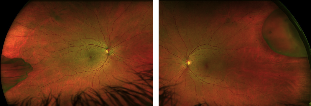 49 y/o woman referred for 'temporal retinal tears, atrophy, or schisis. Please evaluate STAT, car accident head injury'