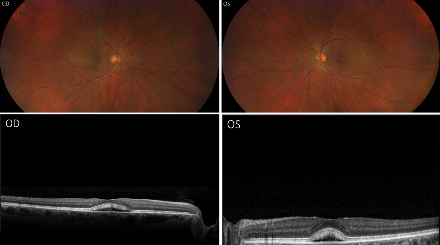 55 year old Caucasian female with a history of bladder cancer was referred for retinal abnormalities. VA 20/25 and 20/30