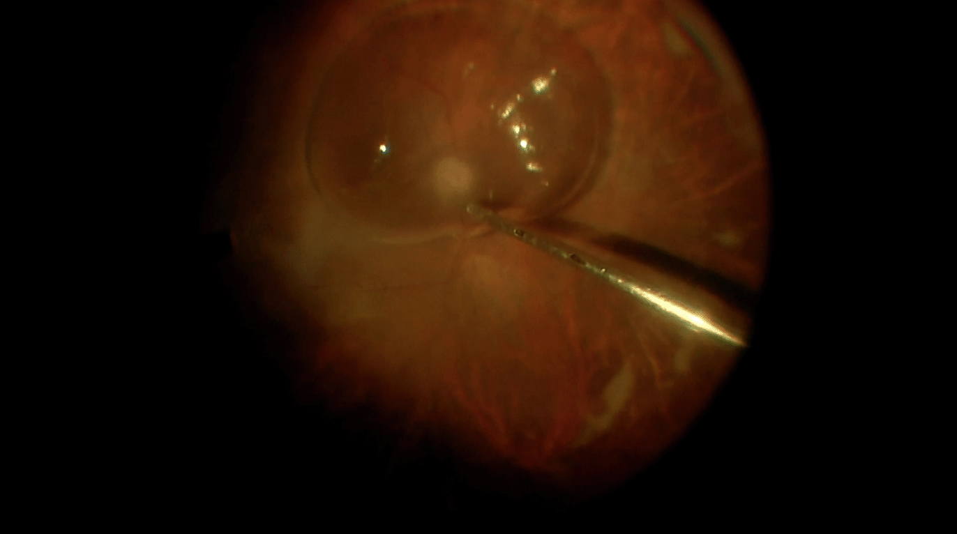 vzv-retinitis-rd-video-with-narration.png